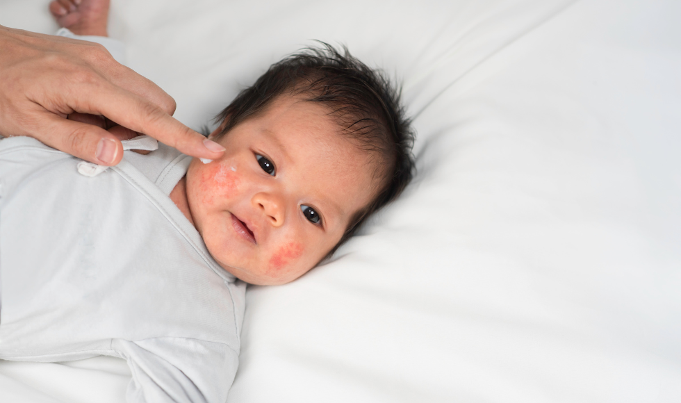 An adult finger dabbing ointment on a baby's adorable chubby cheeks that have a red rash on them.